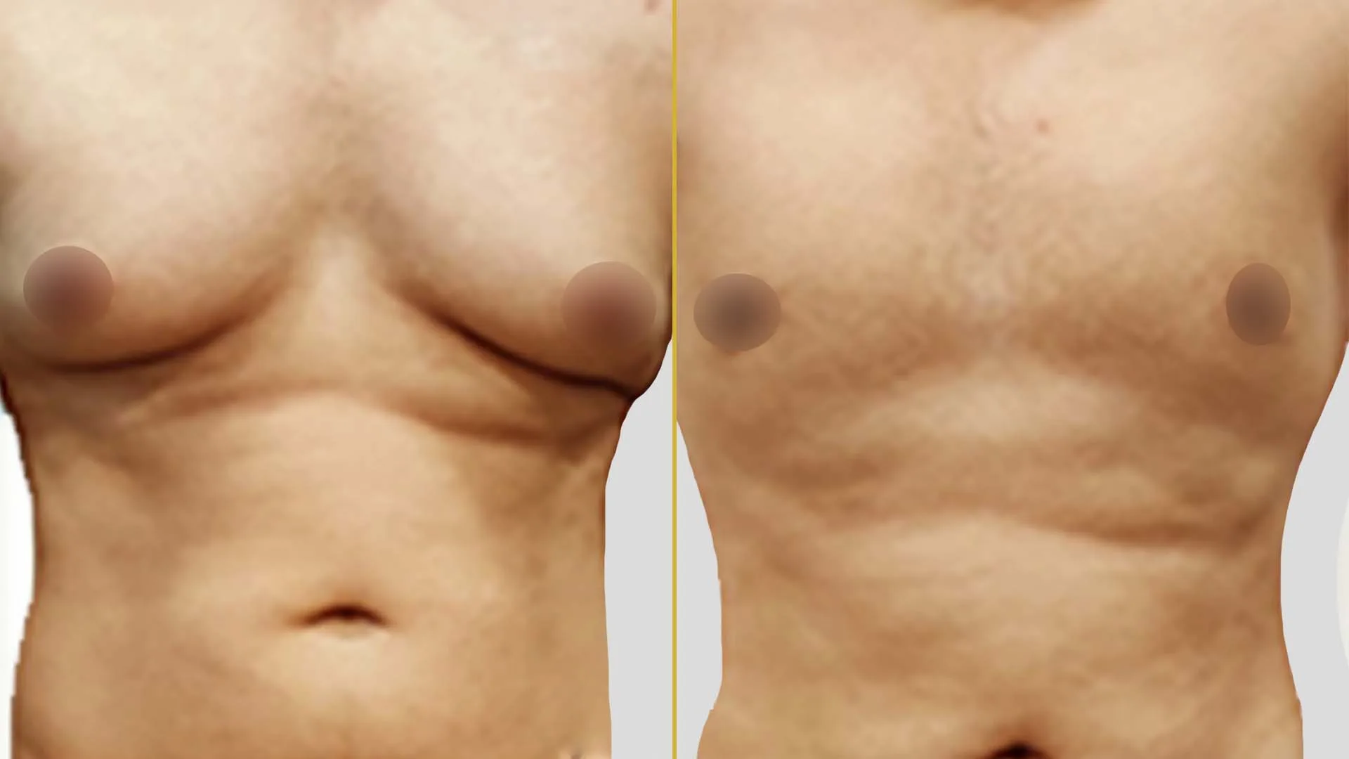 Gynecomastia Treatment before and after result - The Hair and Shape Clinic, Mumbai