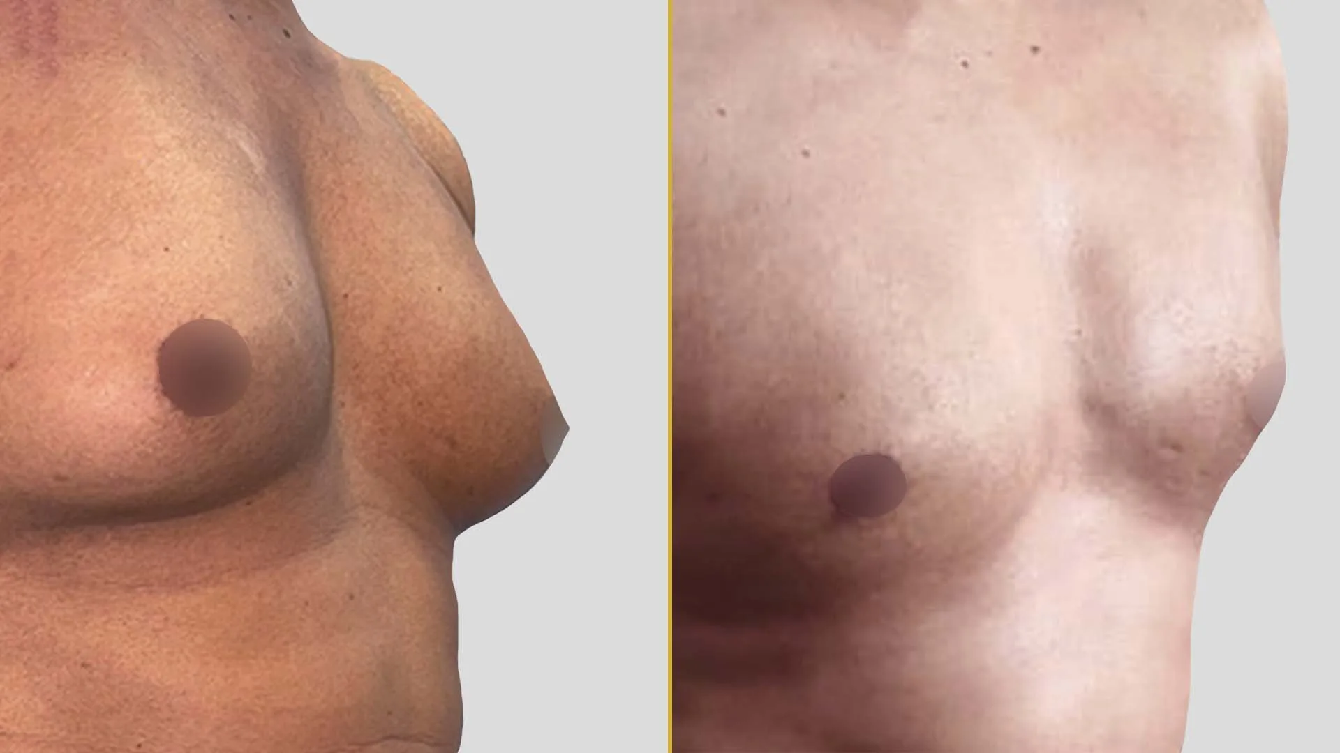 Gynecomastia Treatment before and after result - The Hair and Shape Clinic, Mumbai