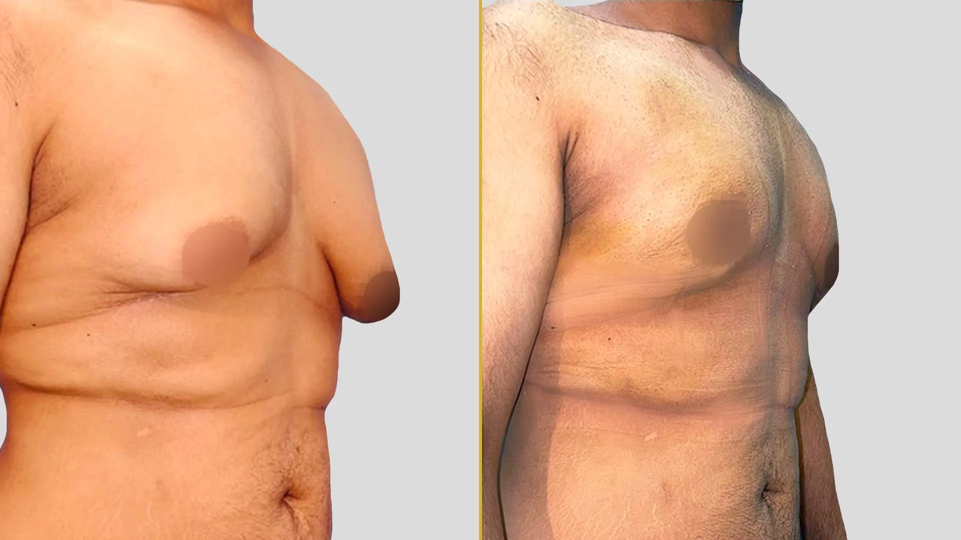 Gynecomastia Treatment before and after result - The Hair and Shape Clinic, Mumbai