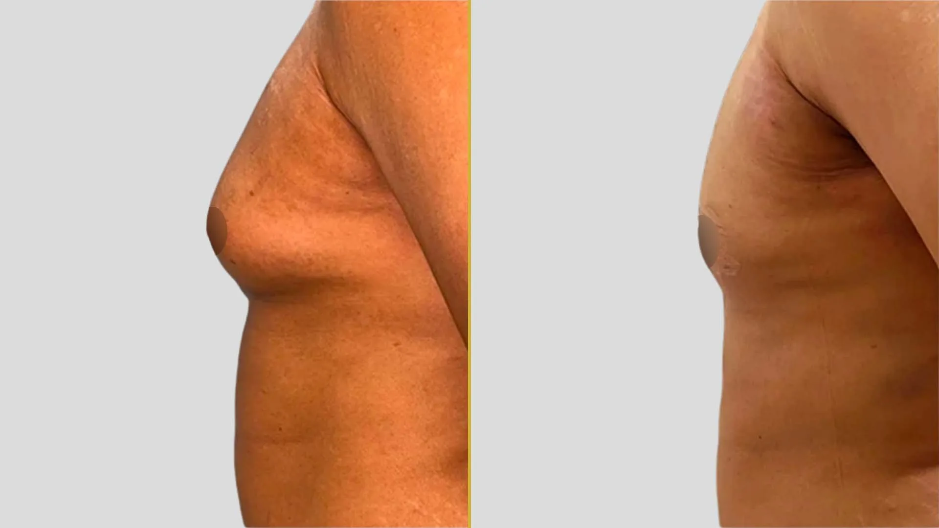 Gynecomastia Treatment before and after result - The Hair and Shape Clinic, Mumbai