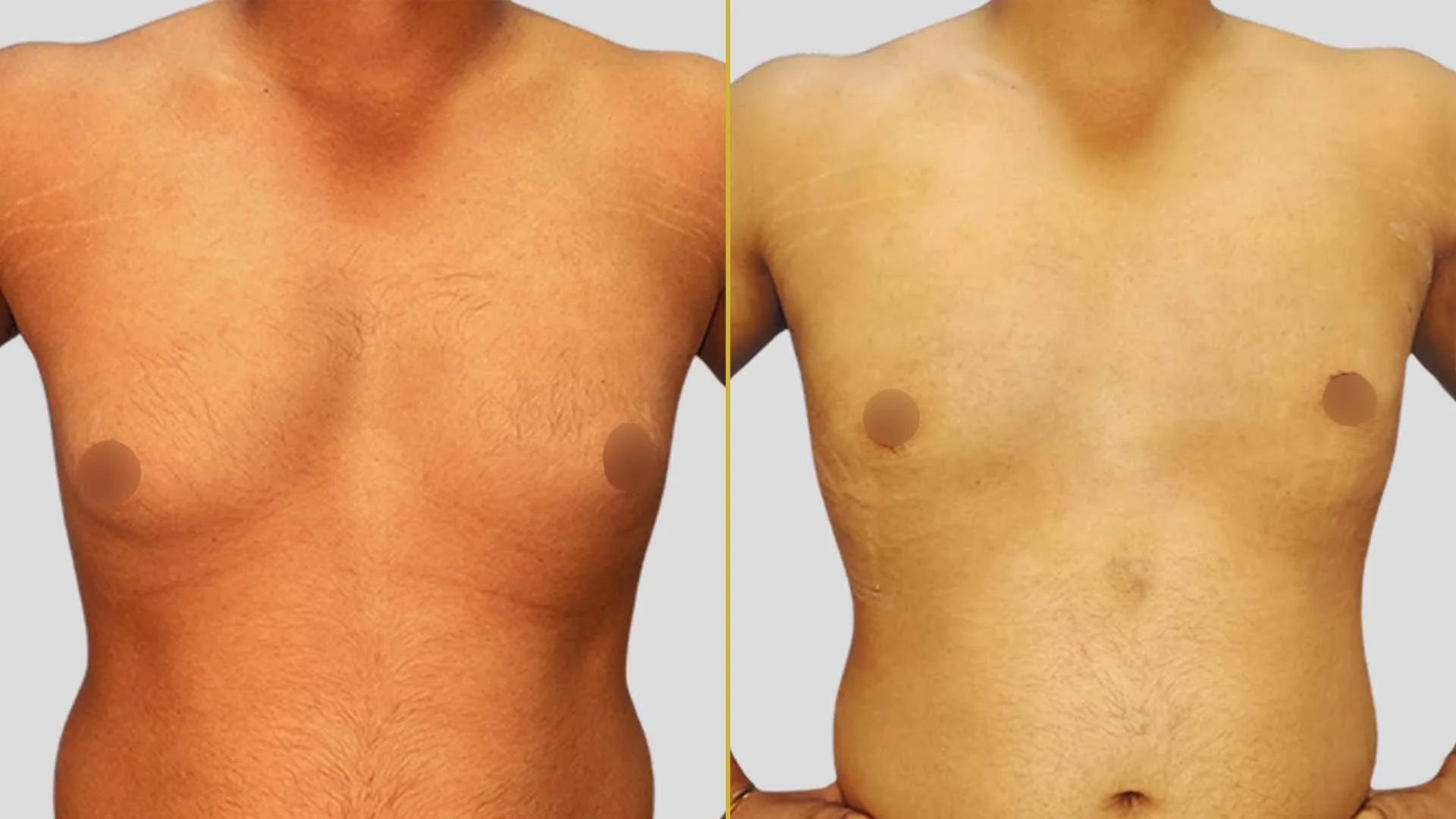 Gynecomastia Treatment before and after result - The Hair and Shape Clinic, Mumbai