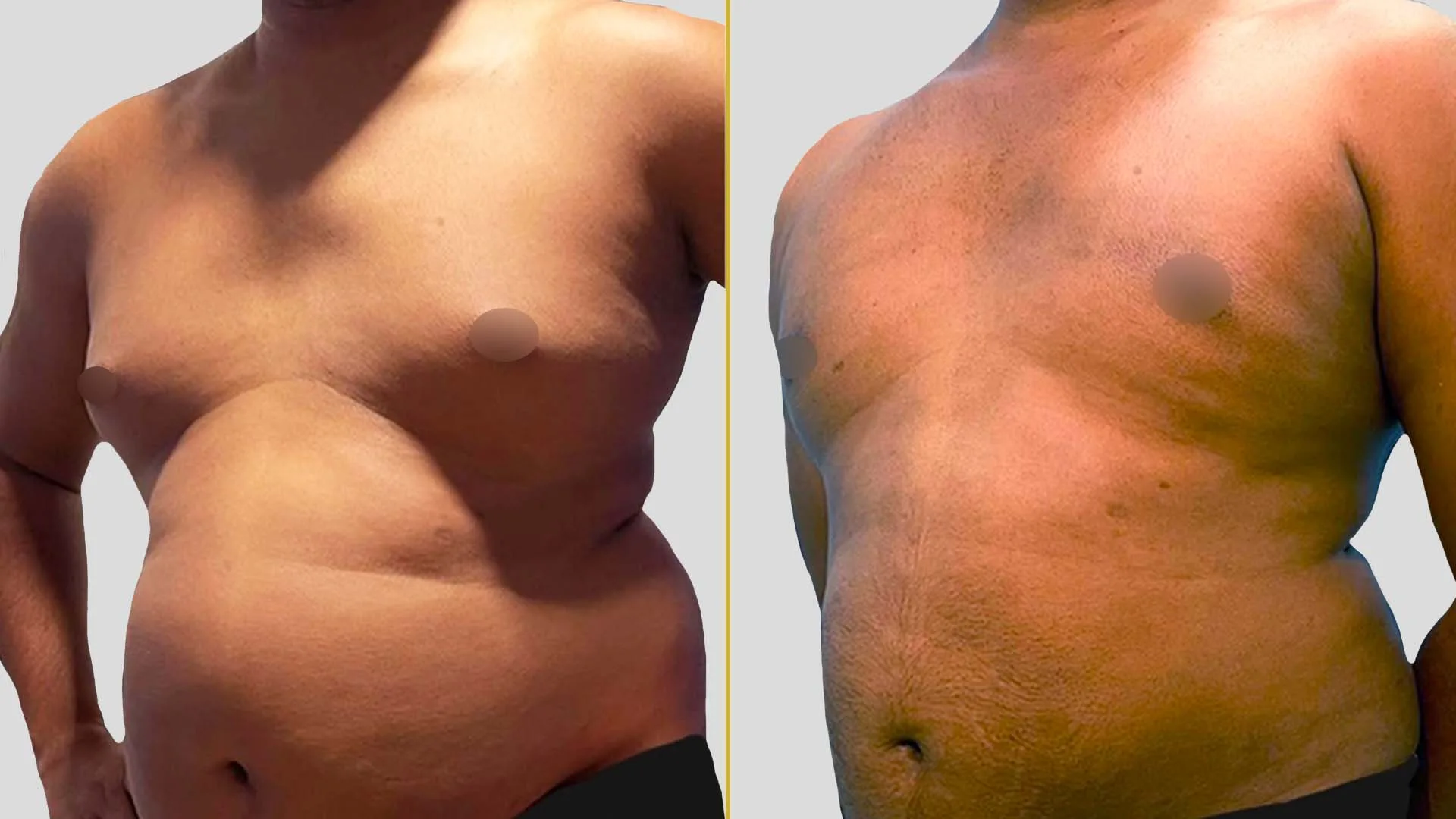 Gynecomastia Treatment before and after result - The Hair and Shape Clinic, Mumbai