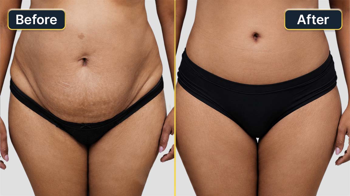 Tummy Tuck Before and After