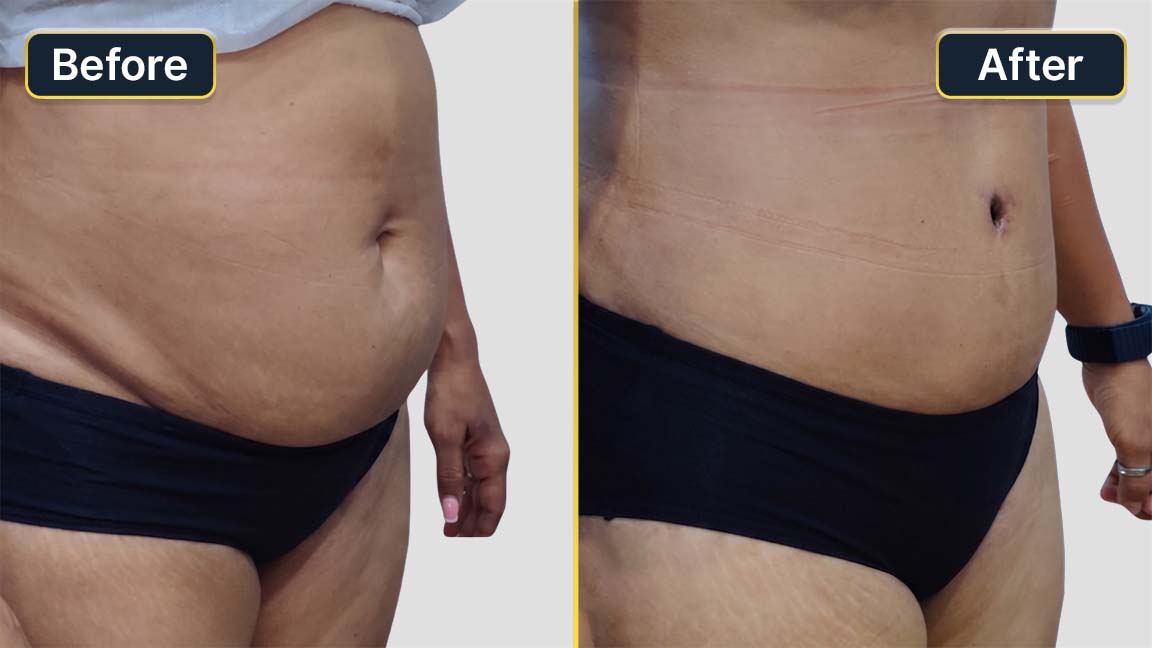 Tummy Tuck Before and After