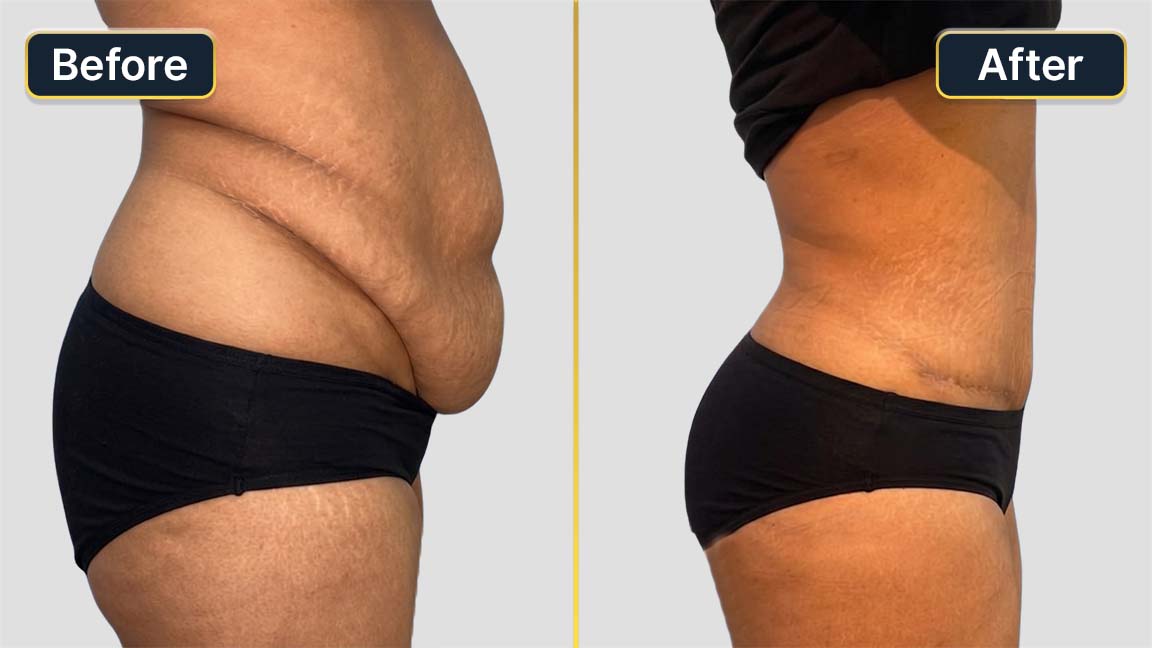 Tummy Tuck Before and After