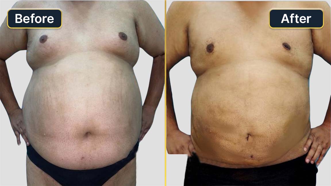 Tummy Tuck Before and After