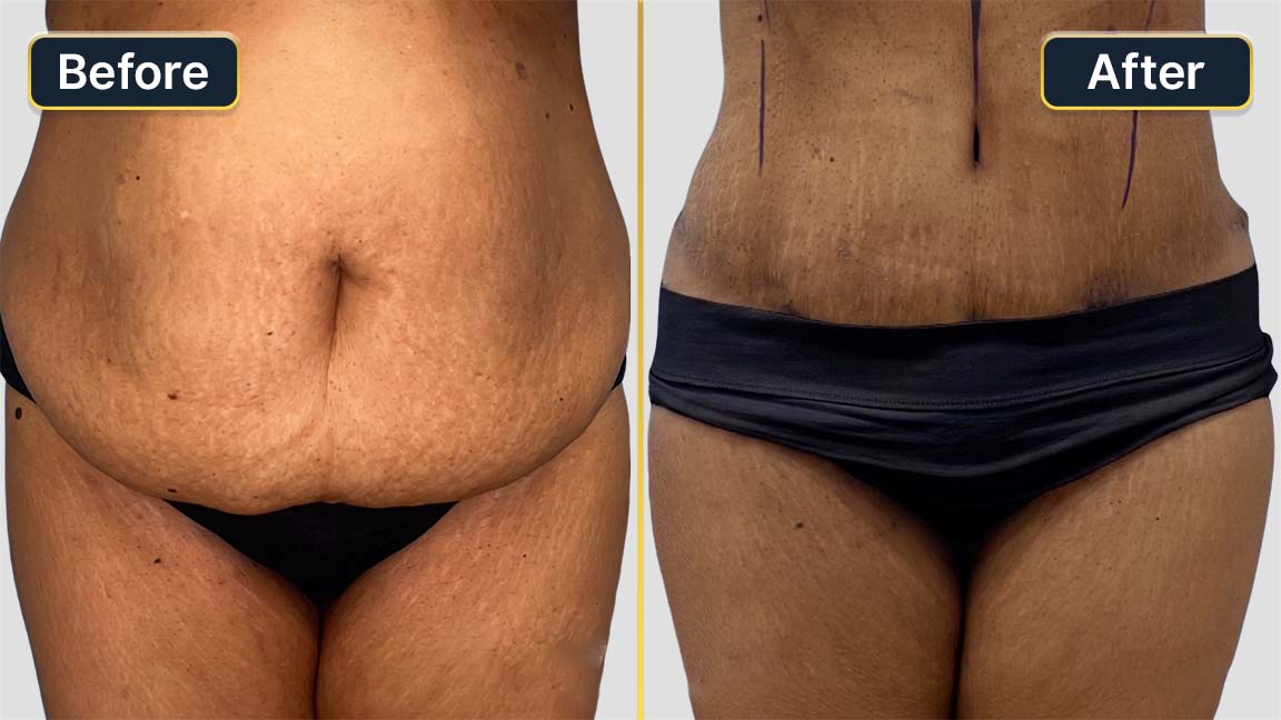 Tummy Tuck Before and After