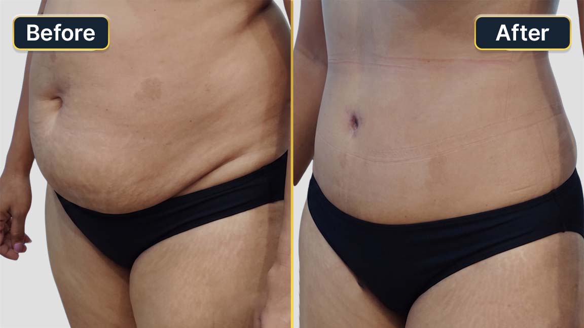 Tummy Tuck Before and After