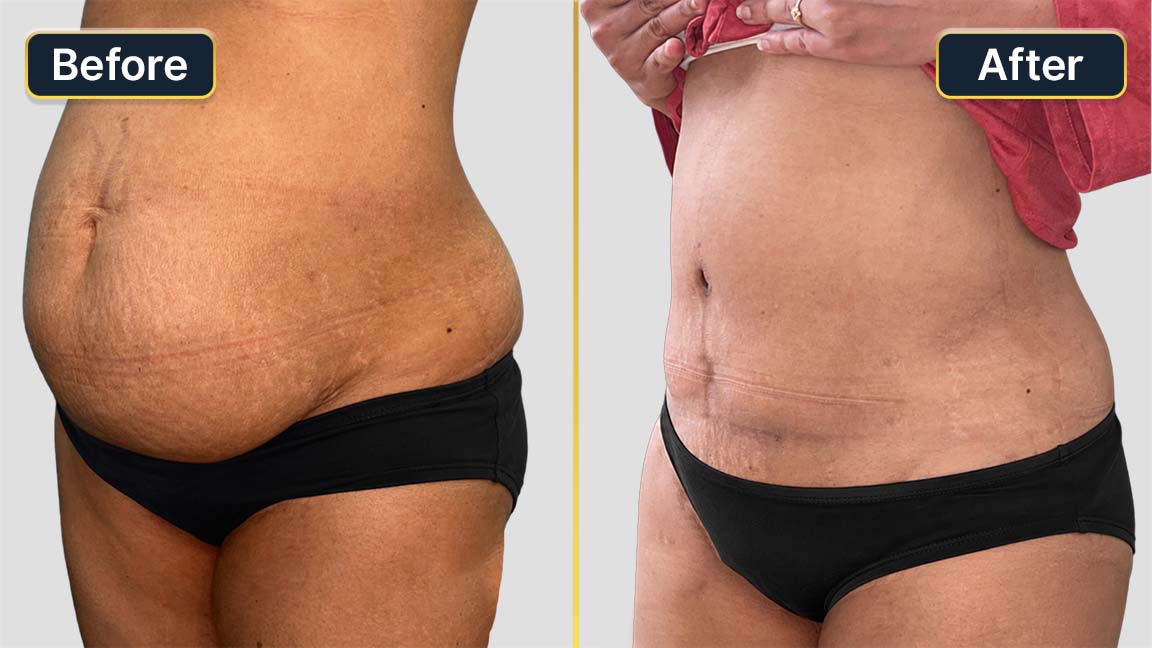 Tummy Tuck Before and After