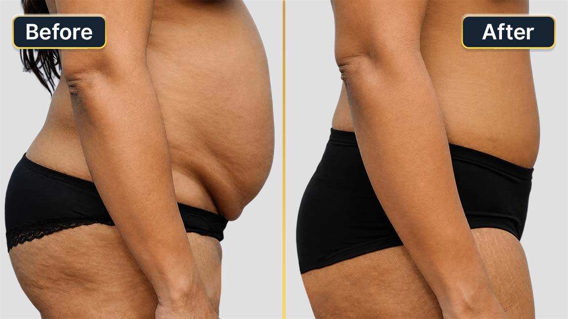 Tummy Tuck Before and After