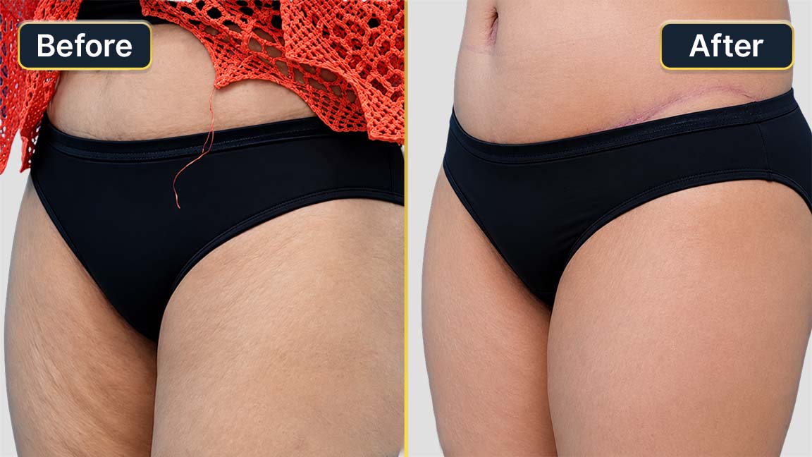 Tummy Tuck Before and After