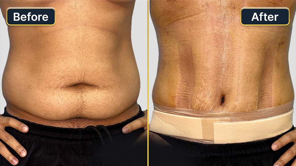 Hi-Definition Liposuction Before and After
