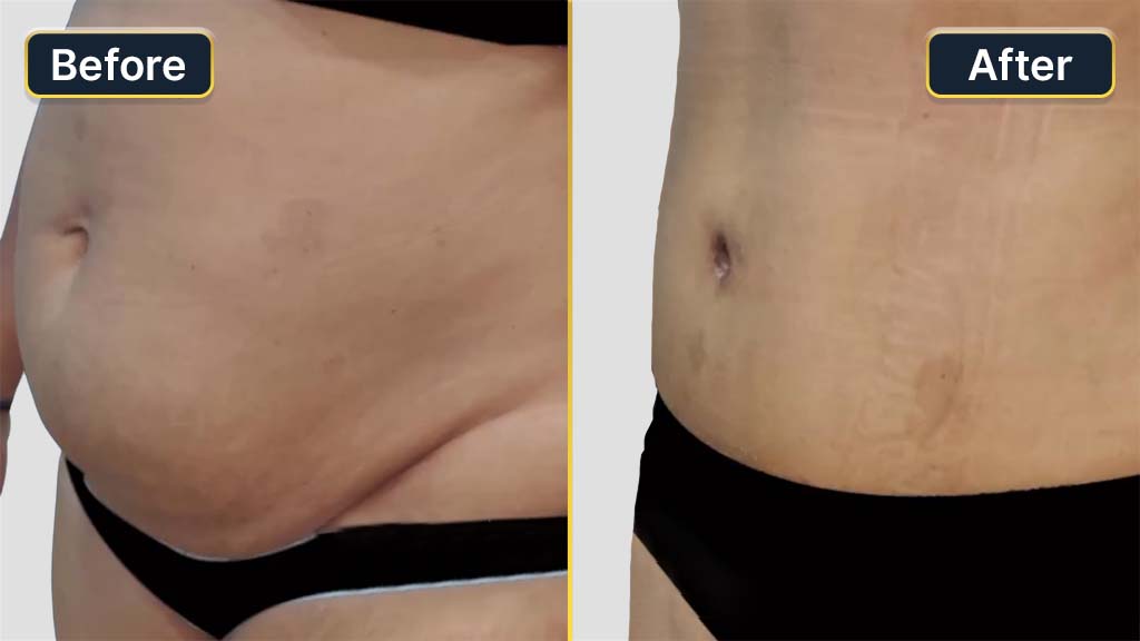 Mommy Makeover Before and After