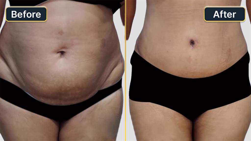 Mommy Makeover Before and After
