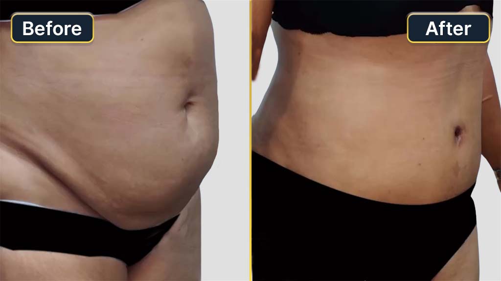 Mommy Makeover Before and After