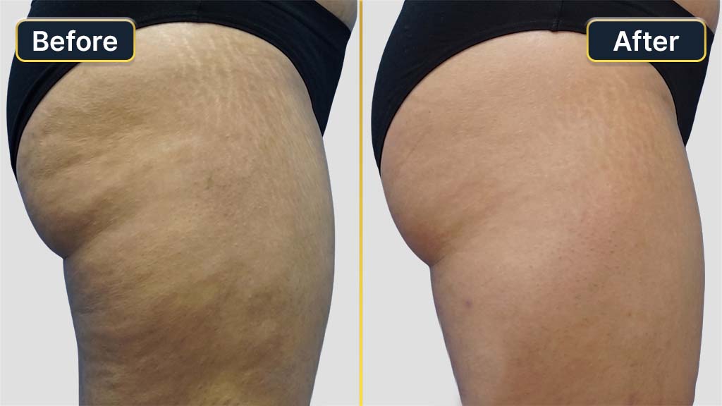 Thigh Contouring Before and After