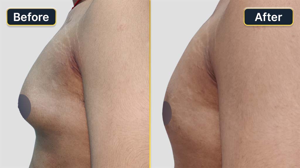 Gynecomastia (Male Boobs) Before and After