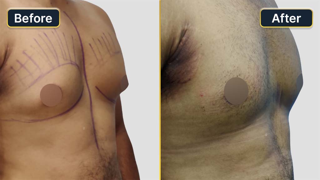 Gynecomastia (Male Boobs) Before and After