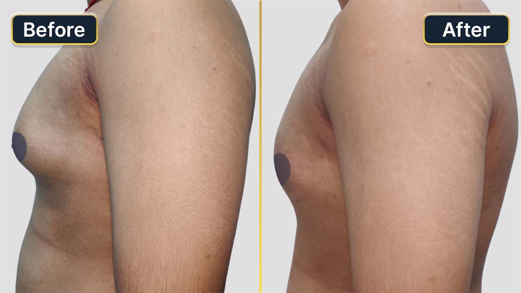 Gynecomastia (Male Boobs) Before and After