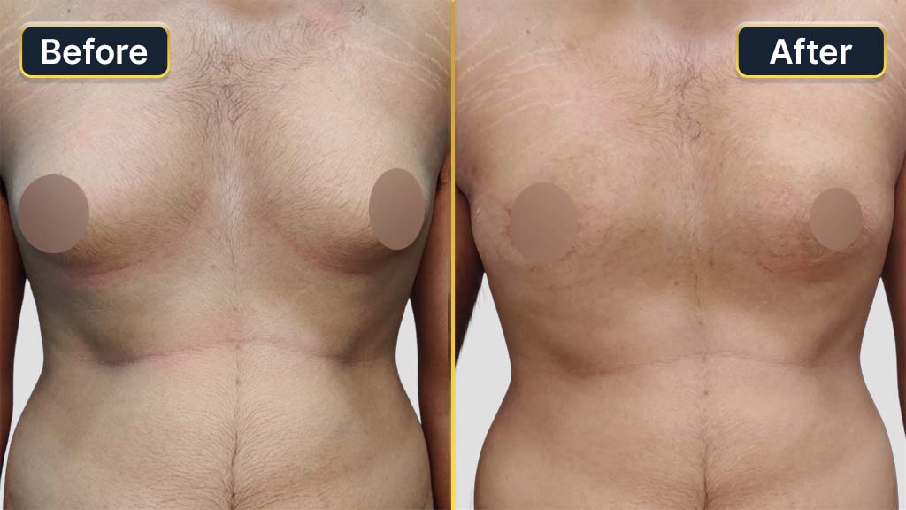 Gynecomastia (Male Boobs) Before and After