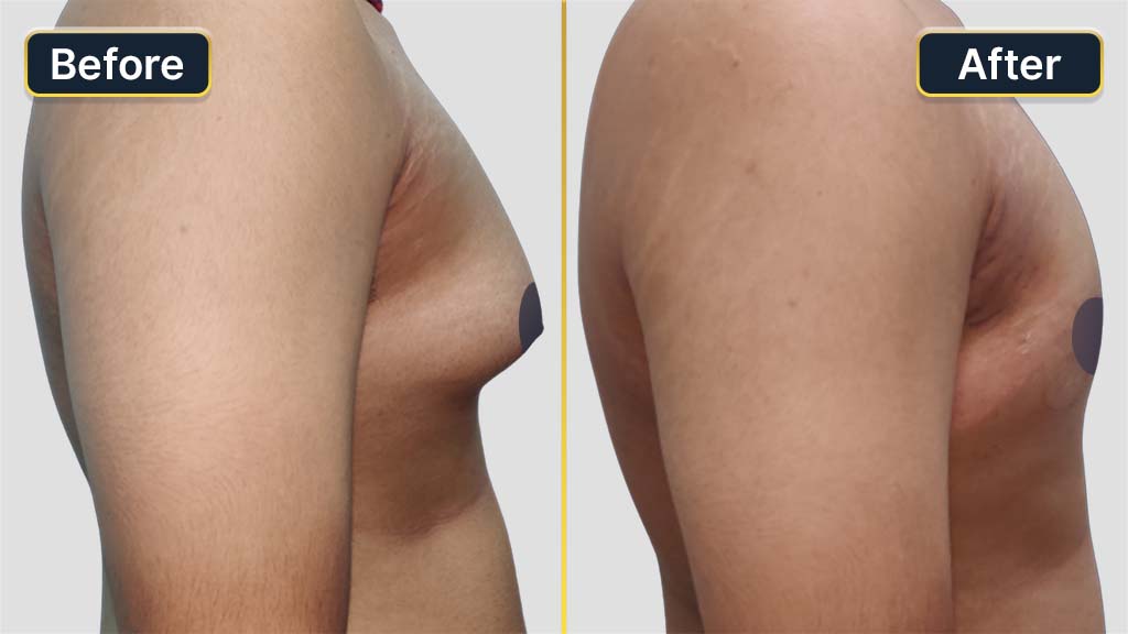 Gynecomastia (Male Boobs) Before and After