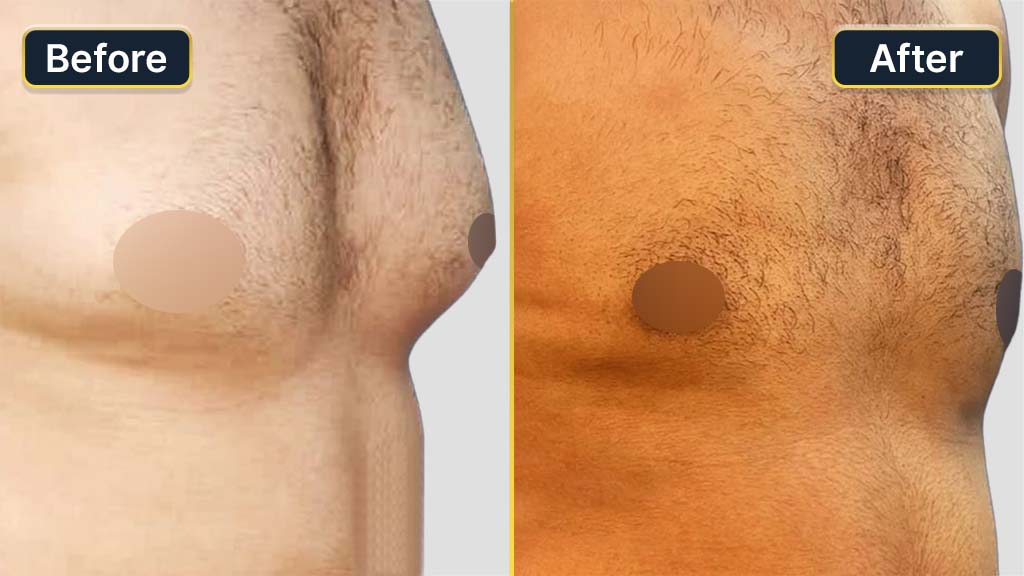 Gynecomastia (Male Boobs) Before and After
