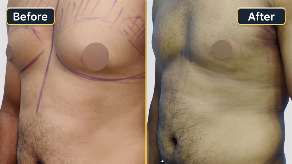 Gynecomastia (Male Boobs) Before and After