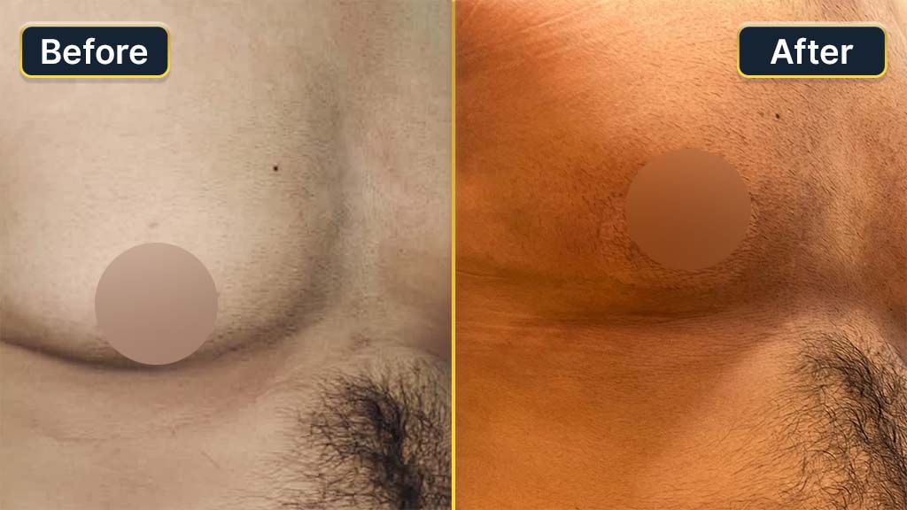 Gynecomastia (Male Boobs) Before and After