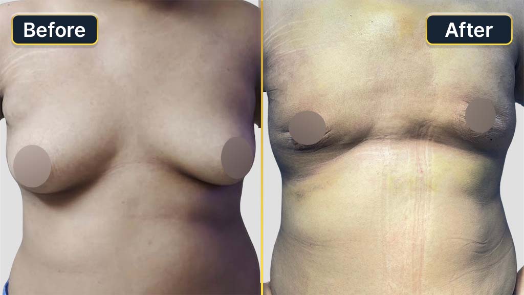 Gynecomastia (Male Boobs) Before and After