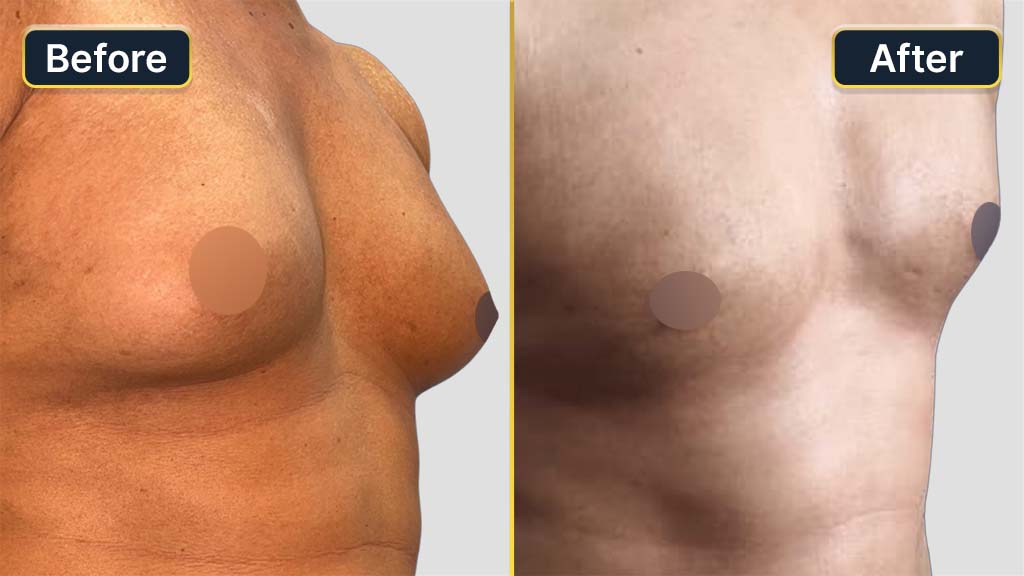 Gynecomastia (Male Boobs) Before and After