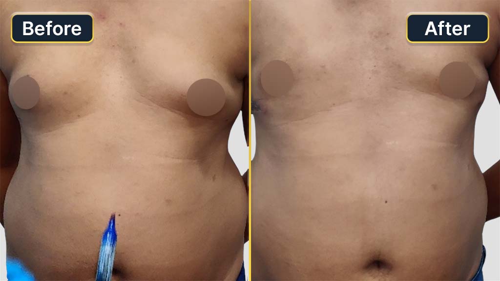 Gynecomastia (Male Boobs) Before and After