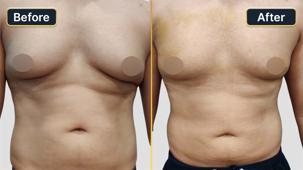 Gynecomastia (Male Boobs) Before and After