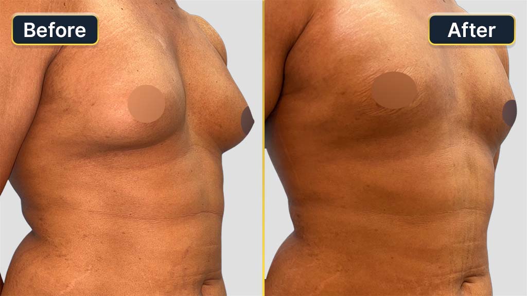 Gynecomastia (Male Boobs) Before and After