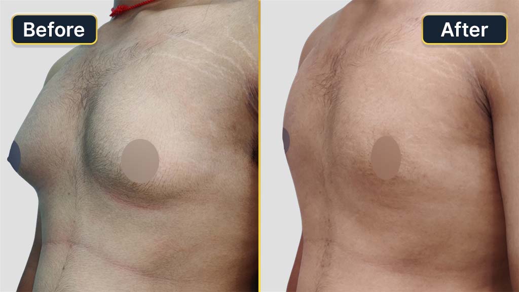 Gynecomastia (Male Boobs) Before and After