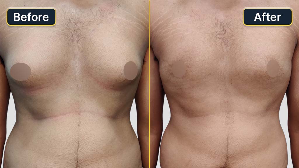 Gynecomastia (Male Boobs) Before and After