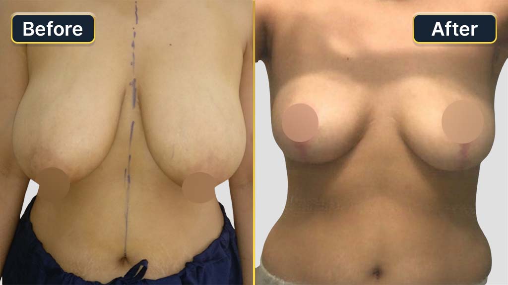 Breast Reduction Before and After