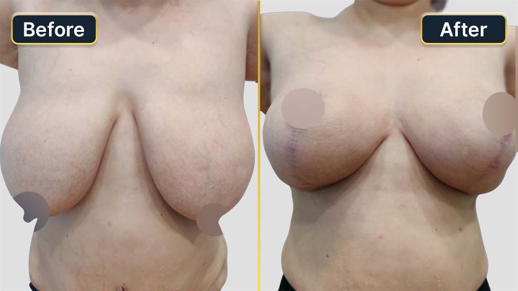 Breast Reduction Before and After