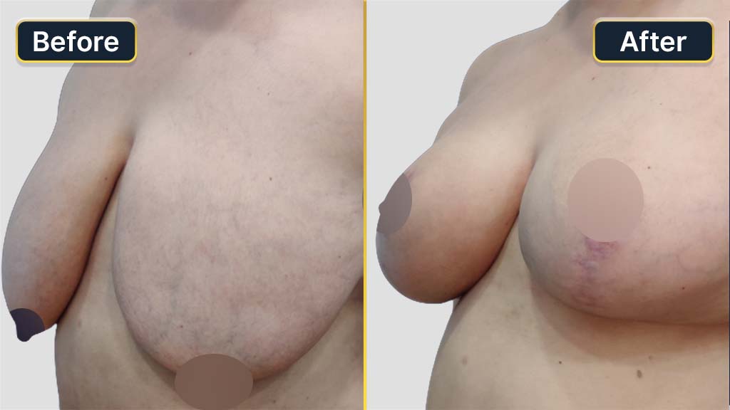 Breast Reduction Before and After