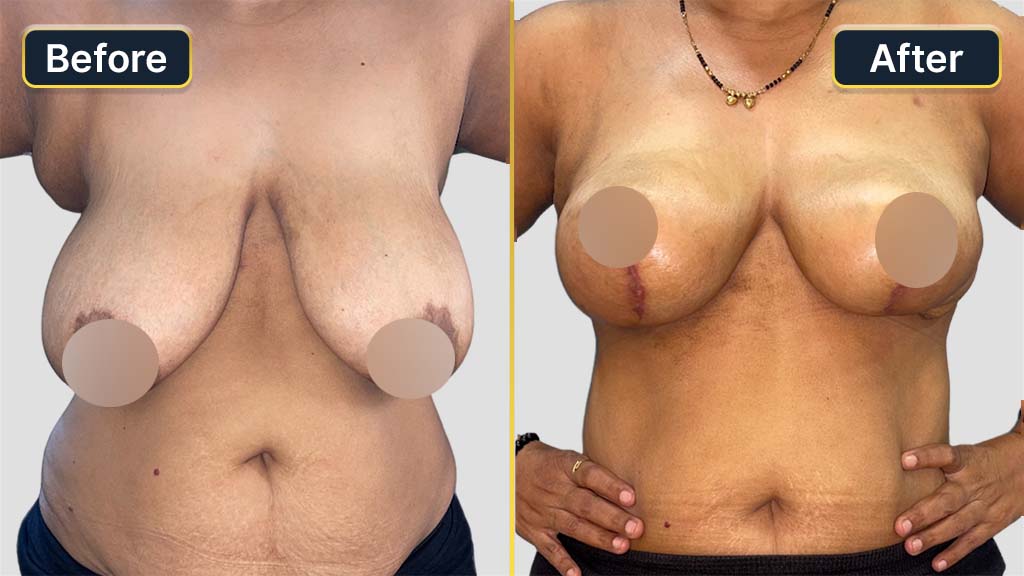 Breast Reduction Before and After