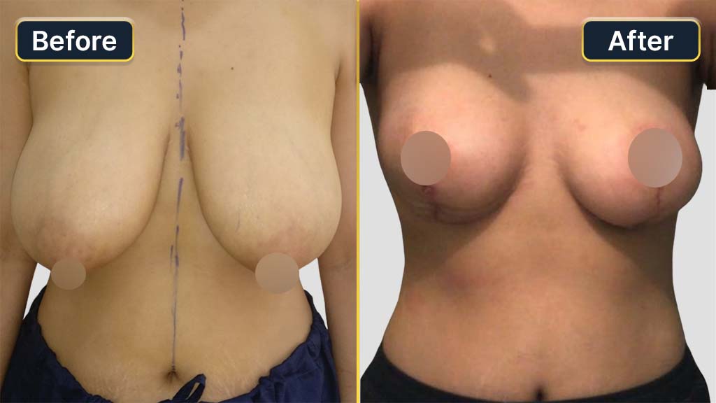 Breast Reduction Before and After