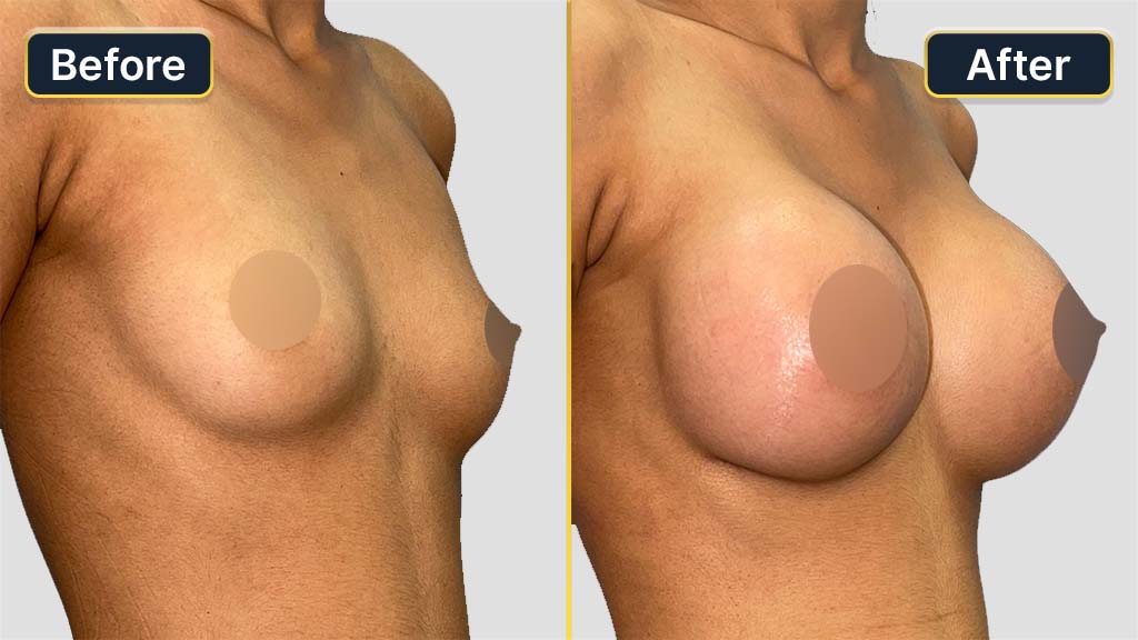 Breast Augmentation Before and After