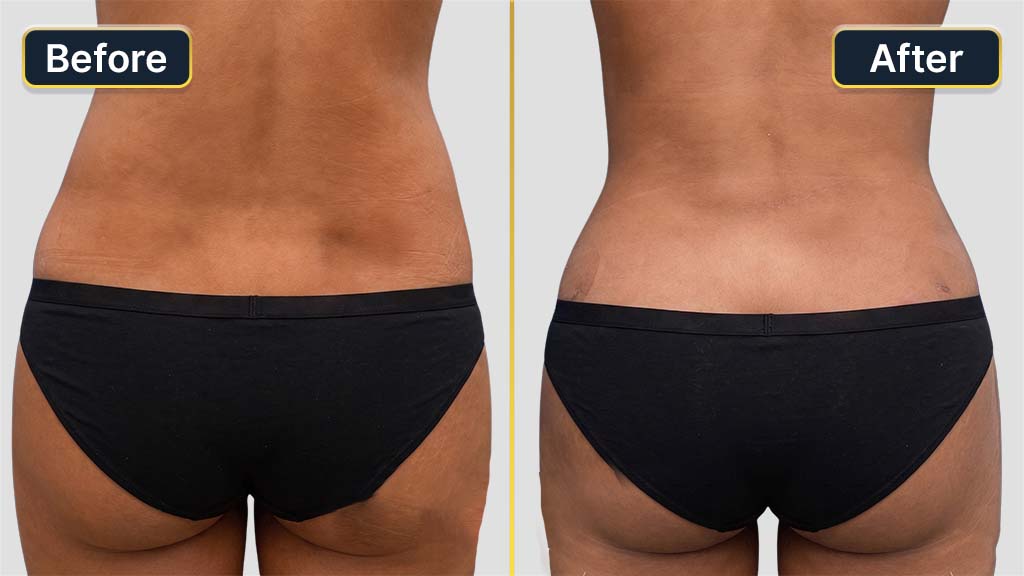 Liposuction Before and After