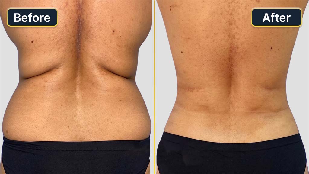 Liposuction Before and After