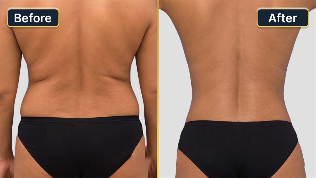 Liposuction Before and After
