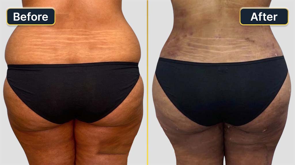 Liposuction Before and After