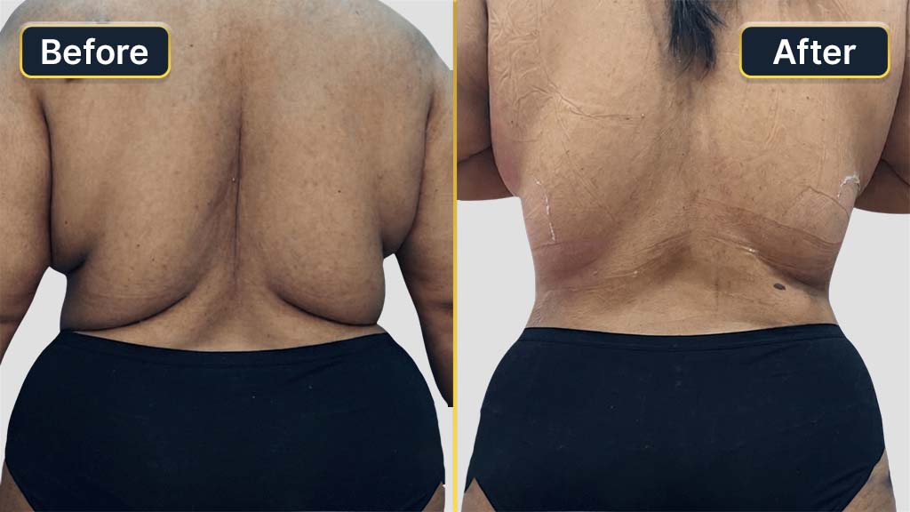 Liposuction Before and After