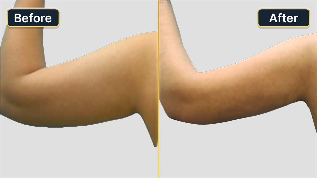 Arm Contouring Before and After