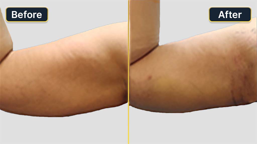 Arm Contouring Before and After