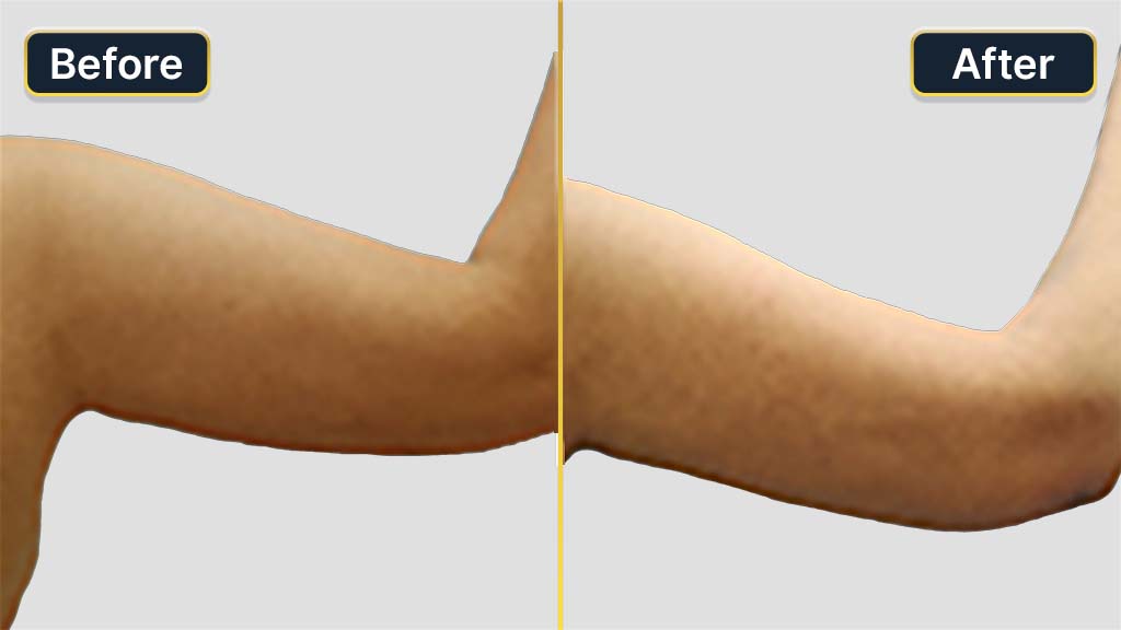 Arm Contouring Before and After