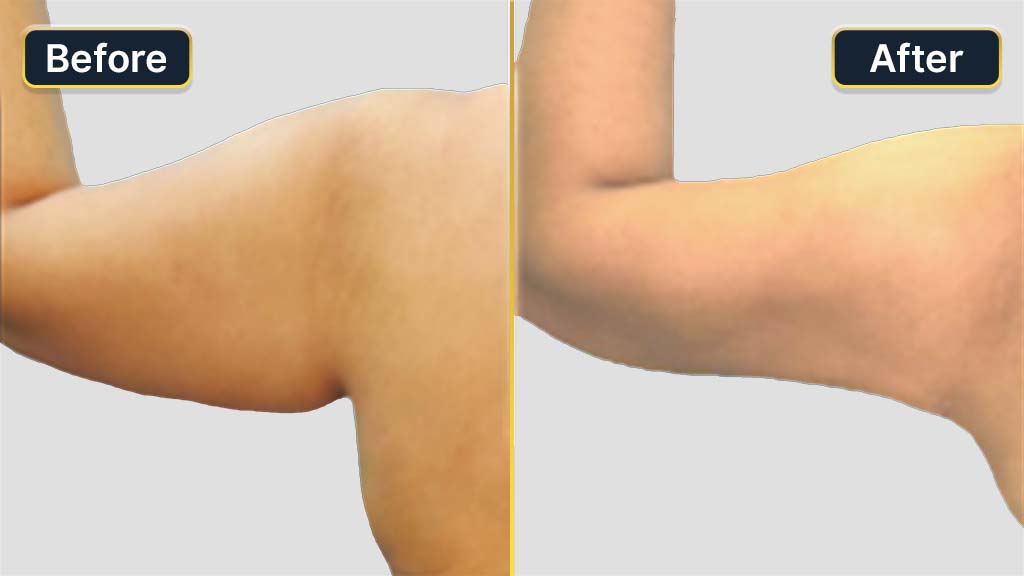 Arm Contouring Before and After